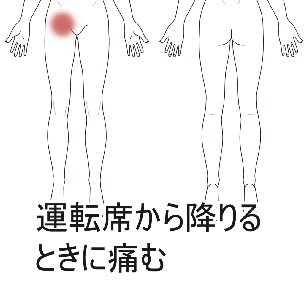 運転席から降りるときの鼠径部の痛み 愛知県安城市の鍼灸院｜はりきゅう専門鍼灸マッサージたかはし